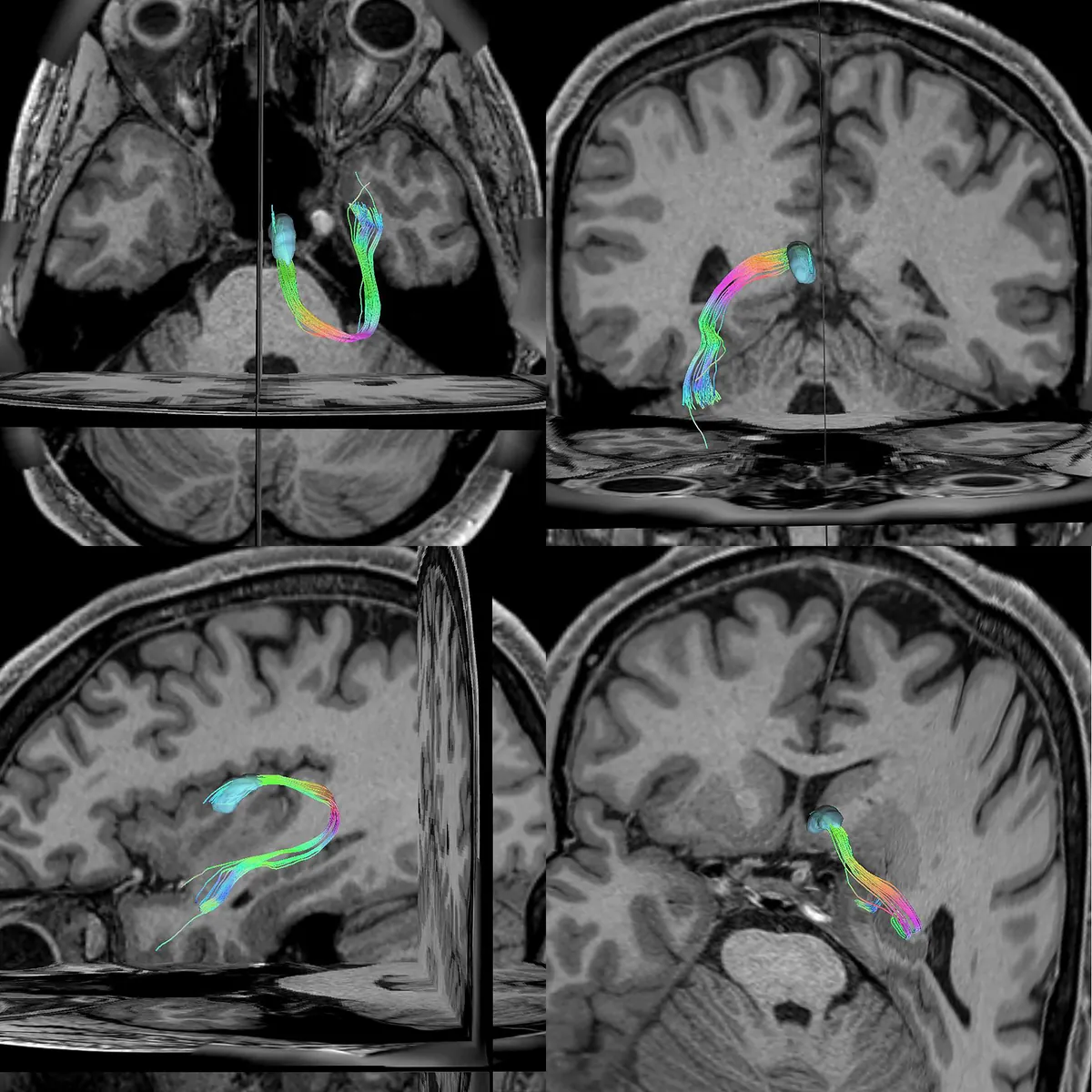 Anterior talamik nükleus ve dorsal anterior talamo-temporal projeksiyonun MR kesitleri üzerinde traktografi gösterimi; Doğruel ve ark., Applied Sciences 2026